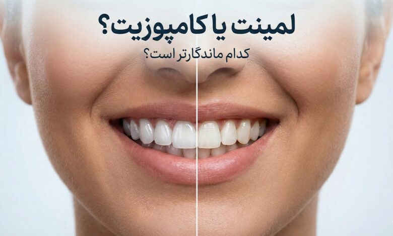 لمینت دندان چند سال دوام دارد؟ مقایسه دقیق لمینت و کامپوزیت